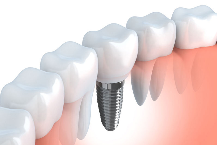 Az implantátumok alkalmazása a legkorszerűbb fogpótlási módszer.