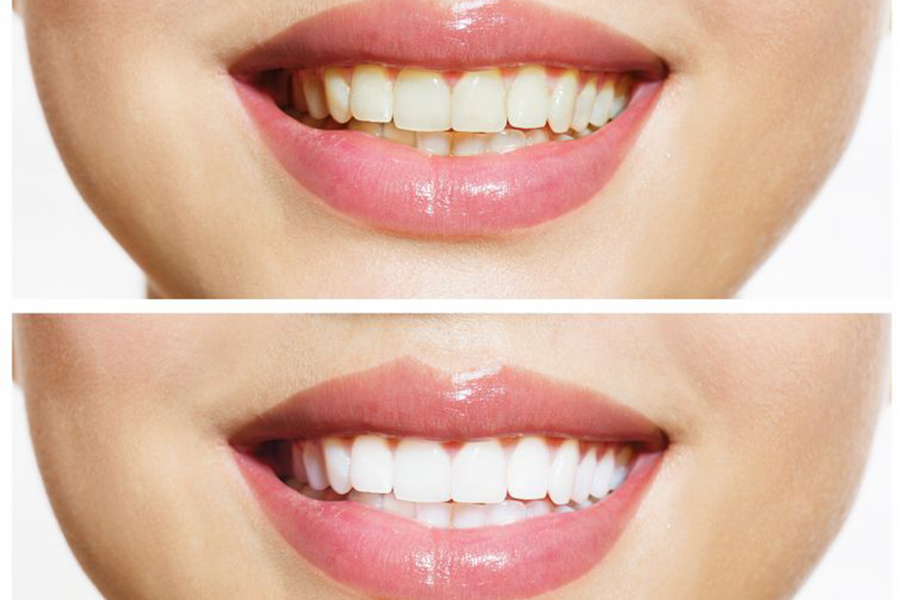 A fogfehérítés során a fogak színét kémiai úton változtatják meg.