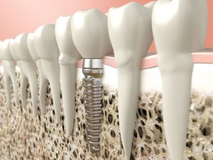 Az implantátumok tökéletesen helyettesítik az elvesztett fogat.